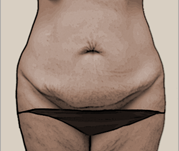abdominoplasty-before-2-web