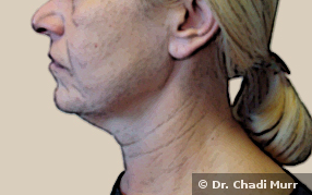 facelift before surgery