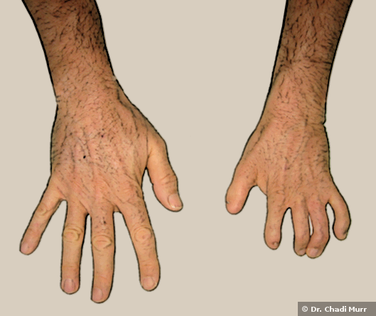 hands deformities web